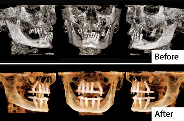 All-on-X Video Course Fusion Dental Academy Course