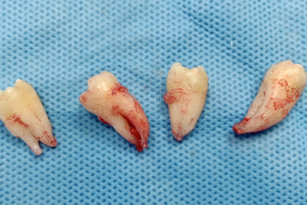 Wisdom Teeth Removal Fusion Dental Academy Course